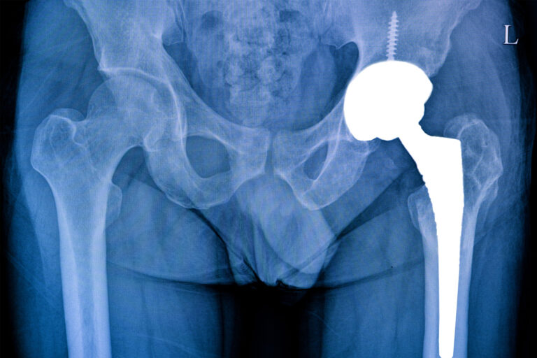 Hip Replacement Surgery All You Need To Know AwayDoc